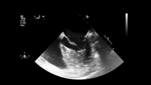 Abbildung Des Herzens Graustufen Modus Während Des Transesophagealen Ultraschalls — Stockfoto