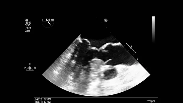 Image Heart Gray Scale Mode Transesophageal Ultrasound — Stock Photo, Image