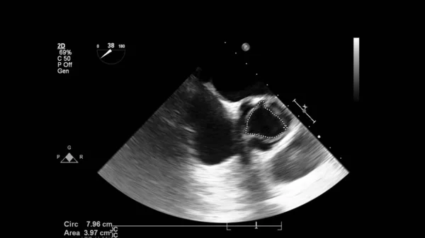 Afbeelding Van Het Hart Grijs Schaal Modus Tijdens Transesofageale Echografie — Stockfoto