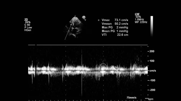 Image Heart Gray Scale Mode Transesophageal Ultrasound — Stock Photo, Image