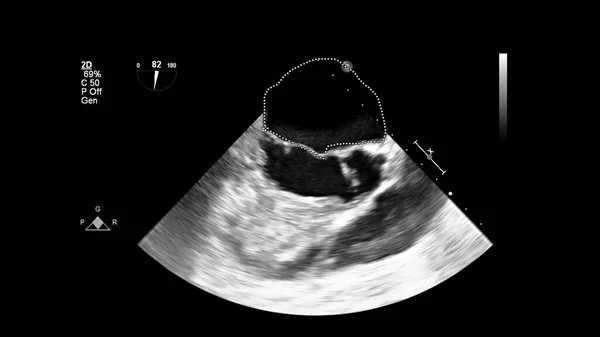 Imagem Coração Escala Cinza Durante Ultrassonografia Transesofágica — Fotografia de Stock
