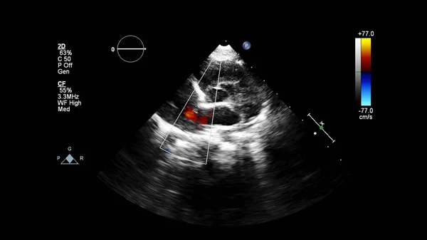 Imagem Coração Durante Ultrassom Transesofágico Com Modo Doppler — Fotografia de Stock