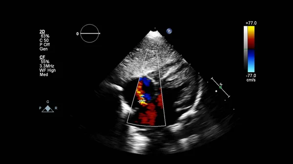 Imagem Coração Durante Ultrassom Transesofágico Com Modo Doppler — Fotografia de Stock