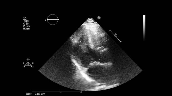 Image of the heart in gray-scale mode during transesophageal ultrasound.