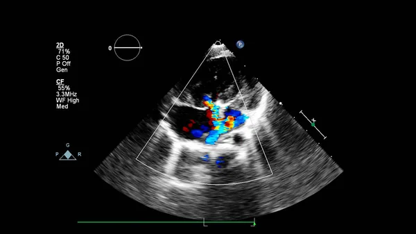 Beeld Van Het Hart Tijdens Transesofageale Echografie Met Doppler Modus — Stockfoto