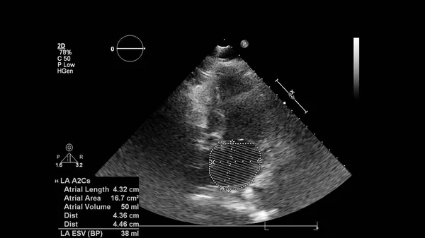 经食管超声下灰度型心脏影像学 — 图库照片