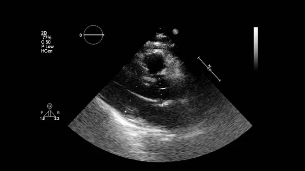 Transesofageal Ultrason Sırasında Kalbin Gri Ölçekli Görüntüsü — Stok fotoğraf