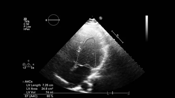 Gambar Jantung Dalam Mode Skala Abu Abu Selama Usg Transesophageal — Stok Foto