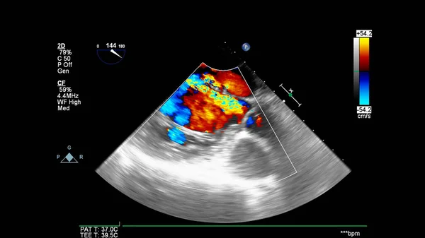 Imagen Del Corazón Durante Ecografía Transesofágica Con Modo Doppler —  Fotos de Stock