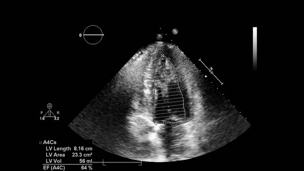 Kép Szív Szürke Skála Mód Során Transesophagealis Ultrahang — Stock Fotó