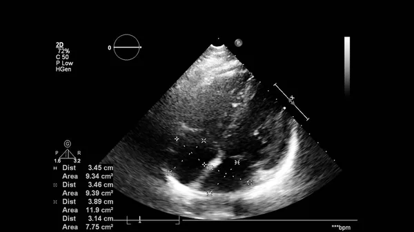 Transesofageal Ultrason Sırasında Kalbin Gri Ölçekli Görüntüsü — Stok fotoğraf