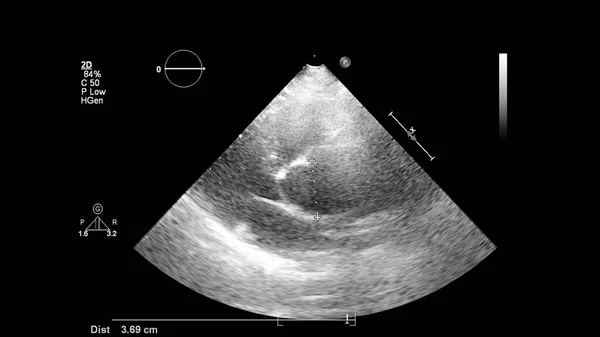 Afbeelding Van Het Hart Grijs Schaal Modus Tijdens Transesofageale Echografie — Stockfoto