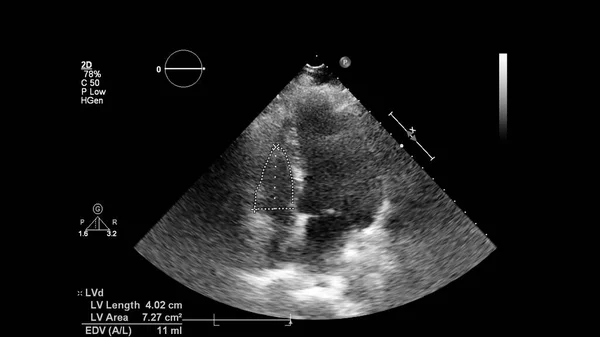 Immagine Del Cuore Scala Grigi Durante Ecografia Transesofagea — Foto Stock
