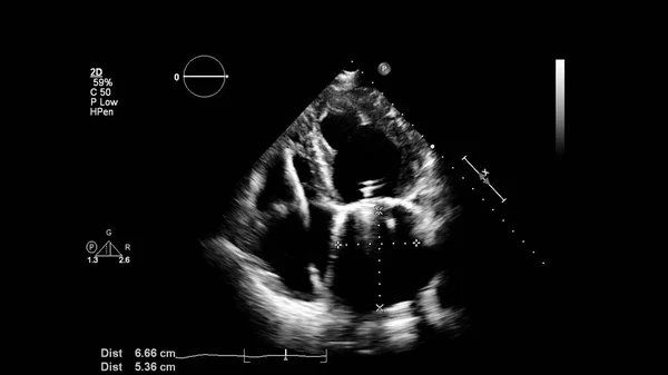 Afbeelding Van Het Hart Grijs Schaal Modus Tijdens Transesofageale Echografie — Stockfoto