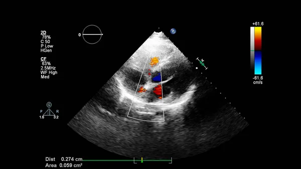 Immagine Del Cuore Durante Ecografia Transesofagea Con Modalità Doppler — Foto Stock