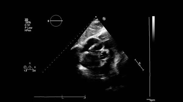 Afbeelding Van Het Hart Grijs Schaal Modus Tijdens Transesofageale Echografie — Stockfoto