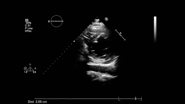 Image Heart Gray Scale Mode Transesophageal Ultrasound — Stock Photo, Image