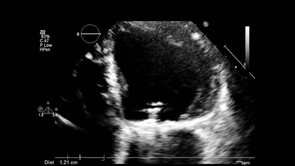 Image Heart Gray Scale Mode Transesophageal Ultrasound — Stock Photo, Image