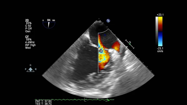 Immagine Del Cuore Durante Ecografia Transesofagea Con Modalità Doppler — Foto Stock