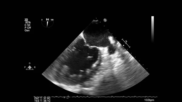 Transesofageal Ultrason Sırasında Kalbin Gri Ölçekli Görüntüsü — Stok fotoğraf