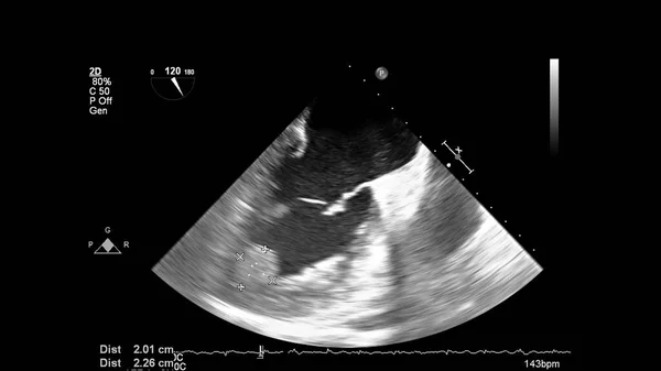 Transesofageal Ultrason Sırasında Kalbin Gri Ölçekli Görüntüsü — Stok fotoğraf