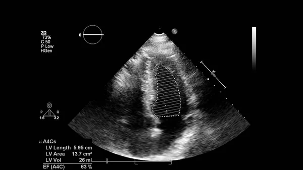 Image Heart Gray Scale Mode Transesophageal Ultrasound — Stock Photo, Image