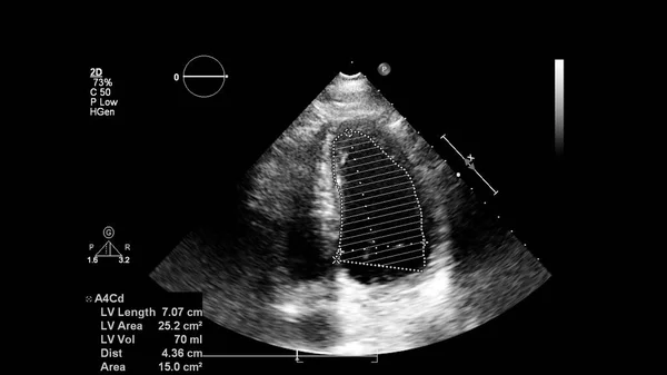 Image Heart Gray Scale Mode Transesophageal Ultrasound — Stock Photo, Image