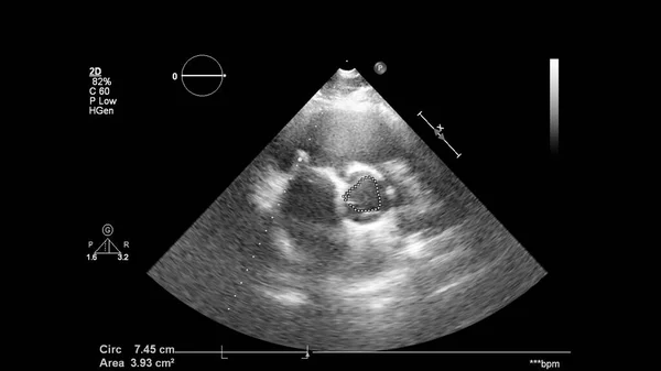 Abbildung Des Herzens Graustufen Modus Während Des Transesophagealen Ultraschalls — Stockfoto