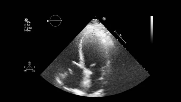 Изображение Сердца Сером Режиме Время Трансофагеального Ультразвука — стоковое фото