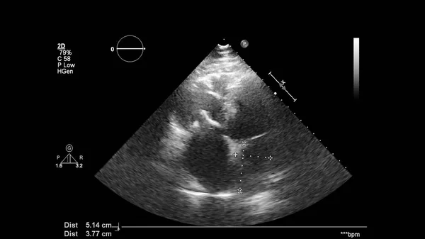 Image Heart Gray Scale Mode Transesophageal Ultrasound — Stock Photo, Image