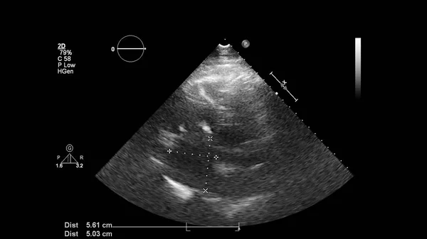 Image of the heart in gray-scale mode during transesophageal ultrasound.