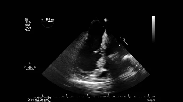 Image Cœur Mode Gris Lors Une Échographie Transœsophagienne — Photo