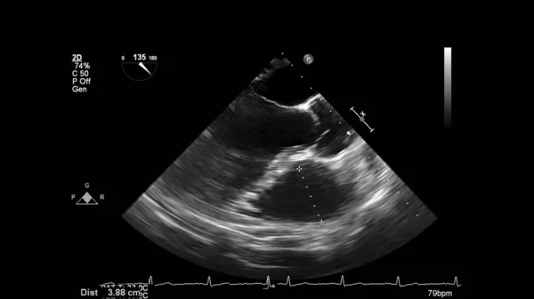 経食道超音波検査時のグレースケールモードで心臓の画像 — ストック写真