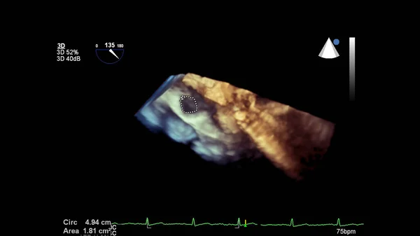 Kép Szív Alatt Transesophagealis Ultrahang — Stock Fotó