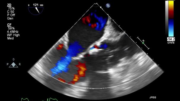 Kalbin Ultrason Transsofageal Muayenesi — Stok video