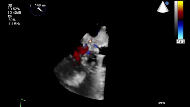 Ultrasound Transesophageal Pemeriksaan Jantung — Stok Video