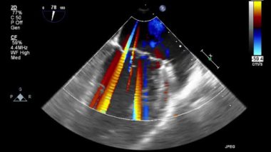 Kalbin ultrason transsofageal muayenesi.