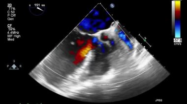 Kalbin ultrason transsofageal muayenesi.