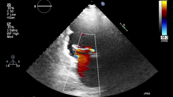Ультразвуковое Трансофагеальное Исследование Сердца — стоковое видео