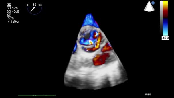 Ultrasound Transesophageal Pemeriksaan Jantung — Stok Video