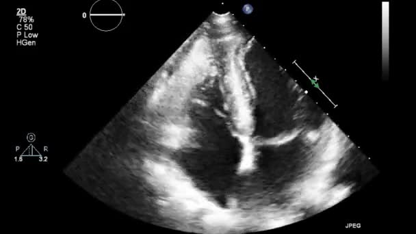 Echografie Transslokdarmonderzoek Van Het Hart — Stockvideo