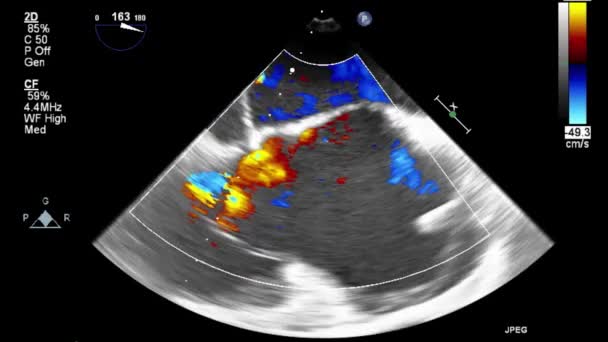 ลตราซาวด การตรวจสอบ Transesophageal ของห วใจ — วีดีโอสต็อก