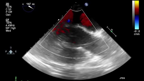 ลตราซาวด การตรวจสอบ Transesophageal ของห วใจ — วีดีโอสต็อก