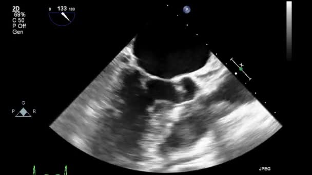 Ultrasound Transesophageal Examination Heart — Stock Video