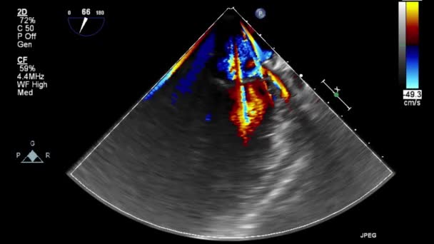 Ultraljudstransesofageal Undersökning Hjärtat — Stockvideo
