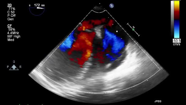 Kalbin Ultrason Transsofageal Muayenesi — Stok video