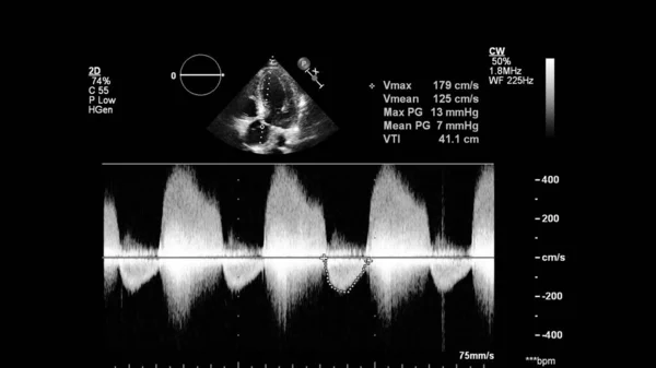 Image of the heart in gray-scale mode during transesophageal ultrasound.