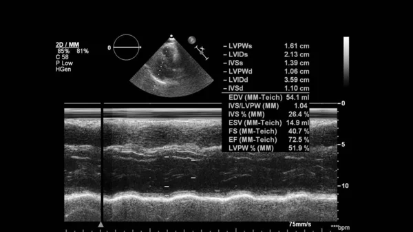 Image of the heart in gray-scale mode during transesophageal ultrasound.