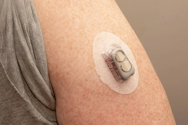 CGM - Continuous glucose monitoring: sensor installed on the upper arm. Transmitter with replaced batteries. Diabetes