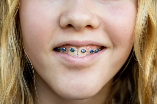 Zbliżenie Nastolatki Metalowych Szelkach Ortodontyczne Aparaty Ortodontyczne Prostują Zęby System — Zdjęcie stockowe